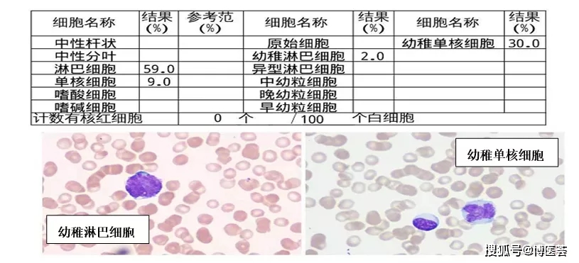 外周血免疫分型检查_免疫血外周型分型检查_外周血免疫分型